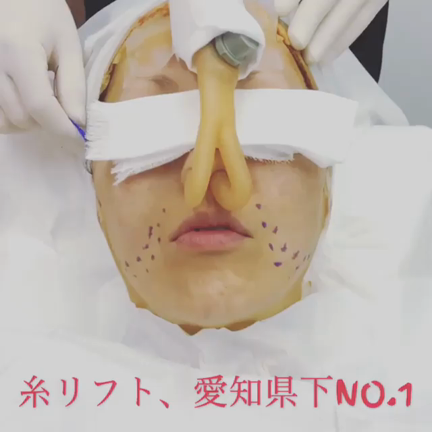 糸によるリフトアップ！2019年度処置件数SBC内で中部エリアNo.1の中野にお任せを！の記事動画