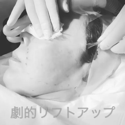 糸によるリフトアップ！2019年度処置件数がSBC内では中部エリアNo.1!中野にお任せ♪の記事動画