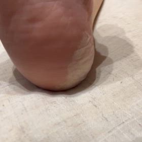 かかとの皮がむけてきてるの画像