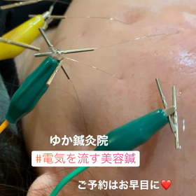 ゆか鍼灸院の電気を流す美容鍼動画の画像