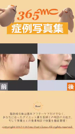 顎下脂肪吸引/二重顎脂肪吸引/脂肪吸引専門365mc病院★顔脂肪吸引症例写真集★の記事動画