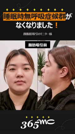 睡眠時無呼吸症候群/脂肪吸引で治療できる/脂肪吸引専門365mc病院の記事動画
