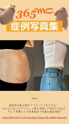 お腹脂肪吸引症例写真集/脂肪吸引専門365mc病院の記事動画