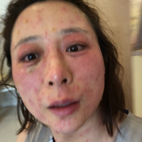 シミ取り放題へ行って来たの画像
