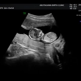 初めての妊婦検診〜13w5d〜注⚠️エコー動画ありの画像