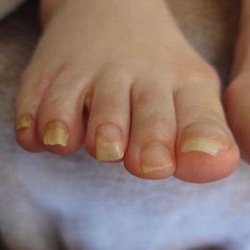 伸びすぎた爪の爪切り、ネイルケアの画像