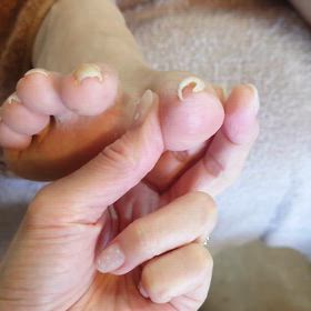 重度の巻き爪補正の画像
