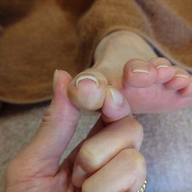 重度の巻き爪補正取付けの画像