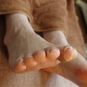 巻き爪補正の画像