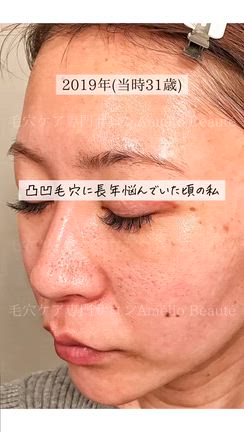 自己紹介【私の黒歴史…毛穴専門サロンってどんな人がやってるの？】の記事動画