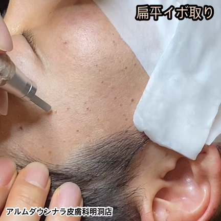 扁平イボ取り、お得な50%割引！！の記事動画