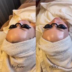 エステ版ダーマケア艶肌爆誕の画像