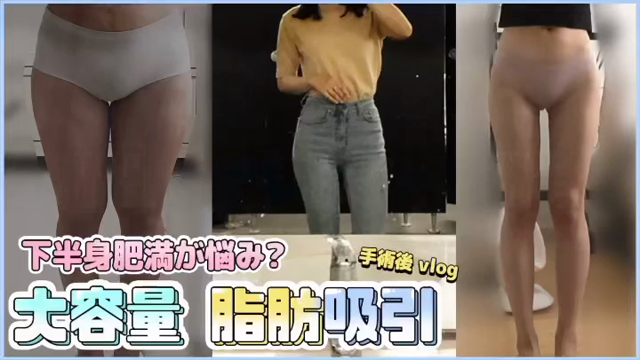 下半身肥満が悩みなら！大容量脂肪吸引！！の記事動画