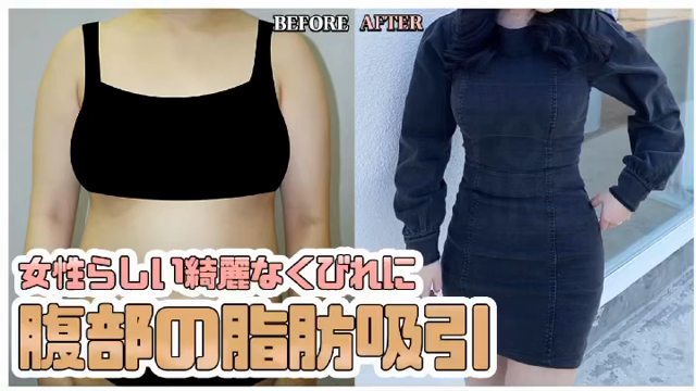 腹部痩せる方法はコレ！狎鴎亭トップライン腹部の脂肪吸引の記事動画