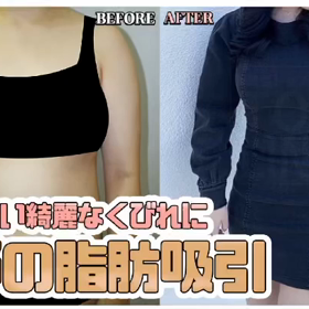 腹部痩せる方法はコレ！狎鴎亭トップライン腹部の脂肪吸引の画像