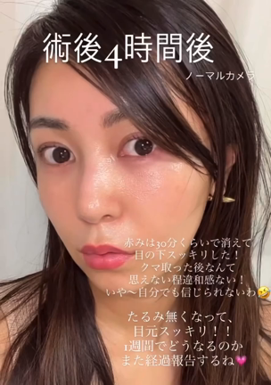 たるみクマ取りの記事動画