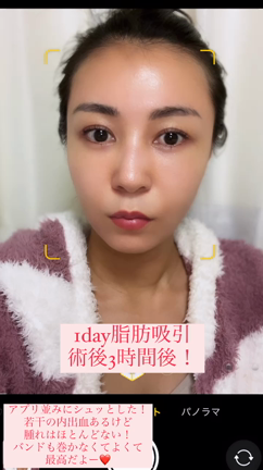 1day脂肪吸引当日の記事動画