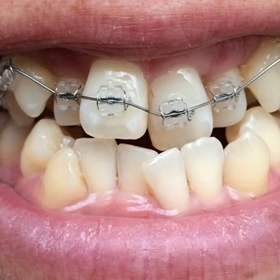 歯が動くさまを動画にしてみたよの画像