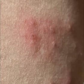 ヘルペスに使用した結果…の画像