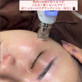 ☆ダウンタイムないのにこんなに効果が？！☆の画像