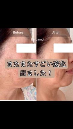たるみケア➕ハーブピーリングですごい変化！の記事動画
