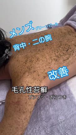 ご新規様・男子高校生グリーンピールボディ・毛孔性苔癬の記事動画
