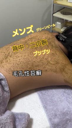 高校生男子・ボディグリーンピール〜毛孔性苔癬背中と二の腕の記事動画