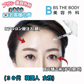 非切開目元矯正術+(額)ヒアルロン酸注入の画像