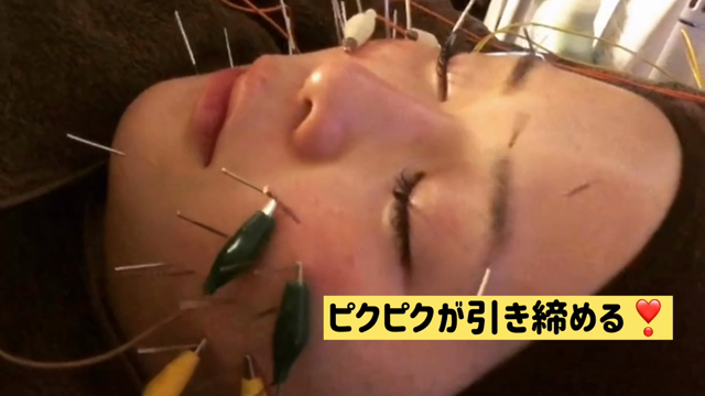 パルス美容鍼風景小顔の為にピクピク電気美容鍼の記事動画