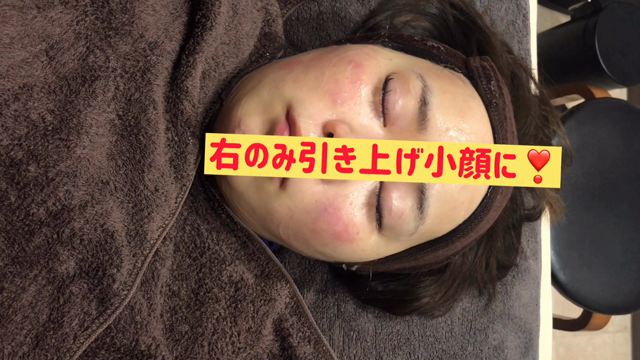 パルス美容鍼風景小顔の為にピクピク電気美容鍼の記事動画