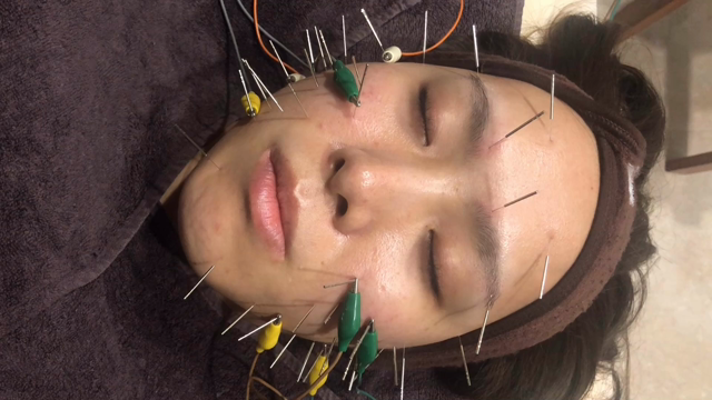 電気の鍼がピクピク刺激的の記事動画