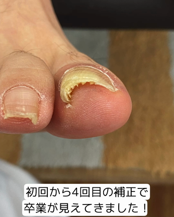 巻き爪補正の記事動画