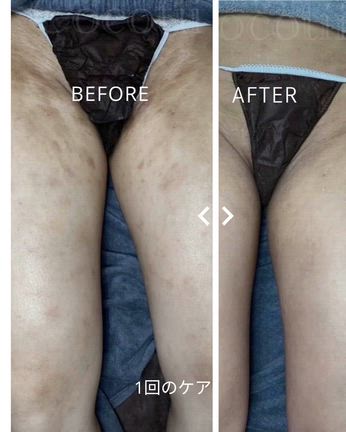 アトピー性皮膚炎　掻きむしりによる色素沈着　毛孔性苔癬　足1回のケア変化の記事動画