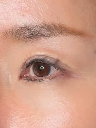 50代女性、先天性眼瞼下垂手術（前頭筋吊り上げ）後の修正の記事動画