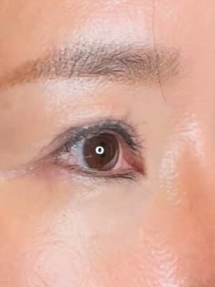 50代女性、先天性眼瞼下垂手術（前頭筋吊り上げ）後の修正の記事動画