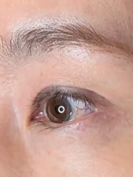 50代女性の初回眼瞼下垂手術　の記事動画