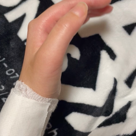 手根管症候群　術後20日目の画像