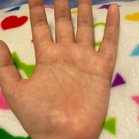 手根管症候群　術後2ヶ月の画像