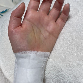 手根管症候群　術後7日目8日目の画像