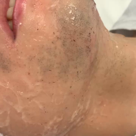 髭脱毛の画像
