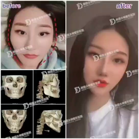 【清潭(チョンダム)女神美容外科】輪郭3点でコンプレックス解消♥  の画像