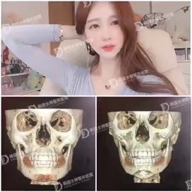 【清潭(チョンダム)女神美容外科】3DCTでみる輪郭3点の変化♥の画像