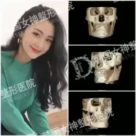【清潭(チョンダム)女神美容外科】輪郭手術第1弾♥3DCT撮影で見る骨の変化～の画像