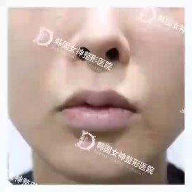 【清潭(チョンダム)女神美容外科】動画で見るビアフ♥内側人中+外側人中+口角挙上+Ｍ字リップの画像