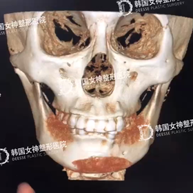 【清潭(チョンダム)女神美容外科】輪郭3点のビフォーアフターを3DCTでチェック♥の画像