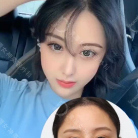 【清潭(チョンダム)女神美容外科】輪郭3点+口角挙上♥の画像