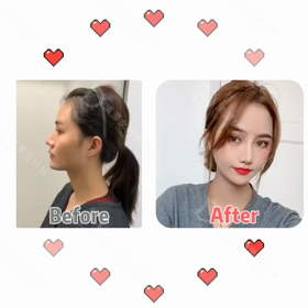 【清潭(チョンダム)女神美容外科】輪郭3点+皮質骨除去+オトガイ後退♥の画像