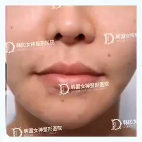 【清潭(チョンダム)女神美容外科】動画で見るビアフ♥口角挙上+Ｍ字リップの画像