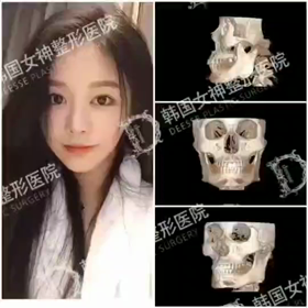 【清潭(チョンダム)女神美容外科】輪郭3点+顎下脂肪吸引サービスで890万w♥？の画像