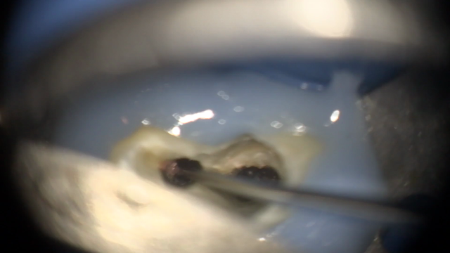 歯の神経の治療。【動画】顕微鏡を使って再根管治療。の記事動画
